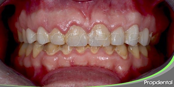¿Qué pasa si no te lavas los dientes en un año?