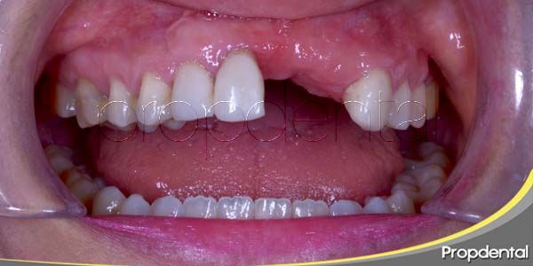 Relación entre la pérdida dental y el deterioro psicológico