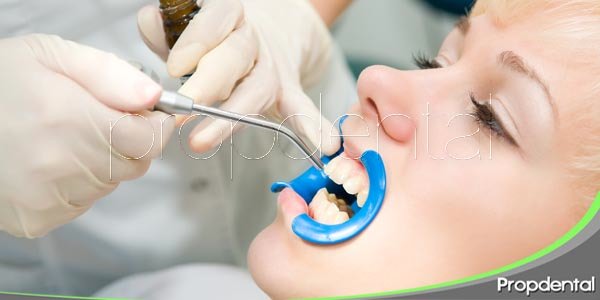 Situaciones idóneas para selladores dentales