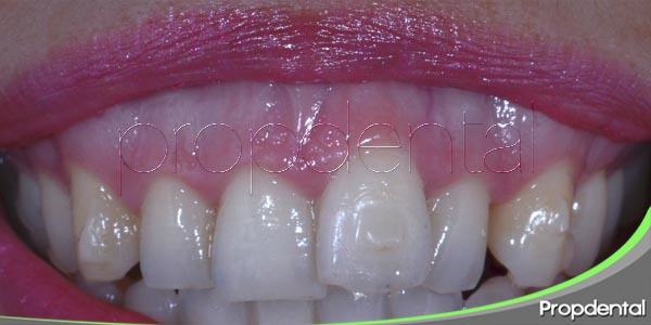¿Cuál es la causa de la aparición de la sonrisa gingival?