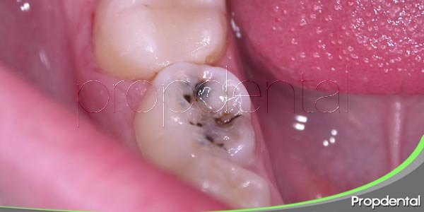 ¿Cuáles son las infecciones orales más habituales?