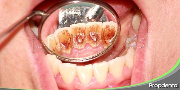 El revelador de placa bacteriana