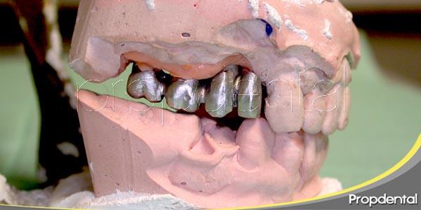 Implantología dental: Factores de riesgo