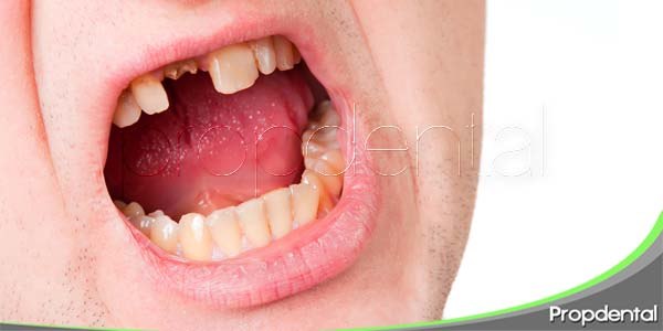 ¿Qué son los dientes podridos?
