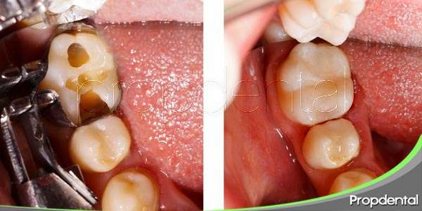 Reconstruir una pieza dental rota