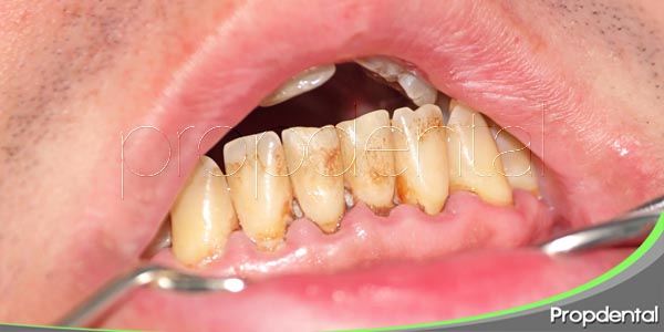¿Se puede evitar la acumulación de placa en los dientes?