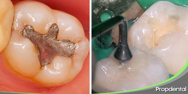 Diferencias entre empaste metálico y empaste de resina