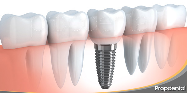 la-supervivencia-de-los-dientes-e-implantes