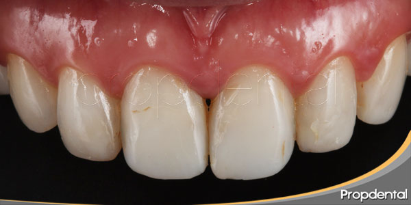se-me-han-oscurecido-los-dientes-¿Por-que?