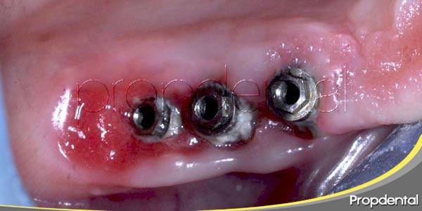 La prevención de enfermedades periimplantarias