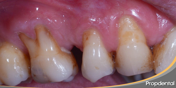 Sintomatología-de-las-enfermedades-periodontales