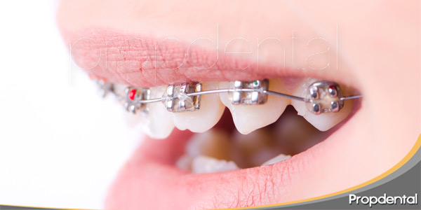 la-importancia-del-cuidado-dental-con-brackets-y-retenedores