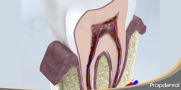 por-qué-se-infecta-el-nervio-dental