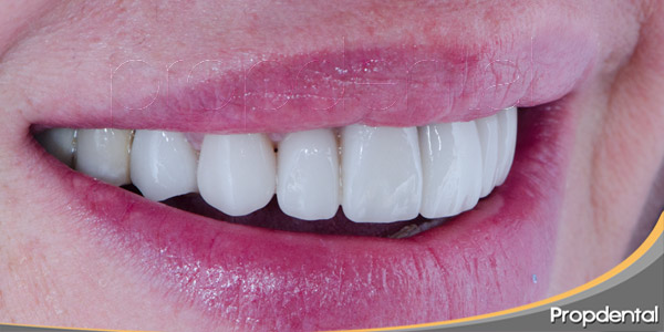 Importancia-estética-de-las-carillas-dentales
