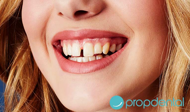 dientes separados forma de corregirlos