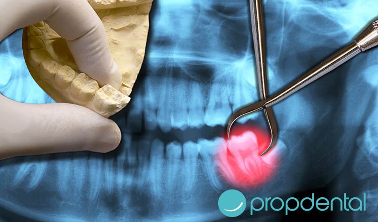 ¿Cuándo es el mejor momento para extraer las muelas del juicio?