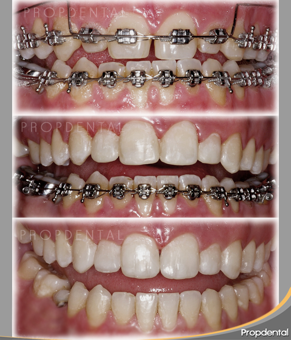 brackets metalicos de ortodoncia