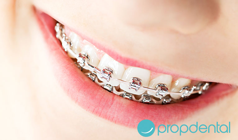 problemas brackets me duelen los dientes