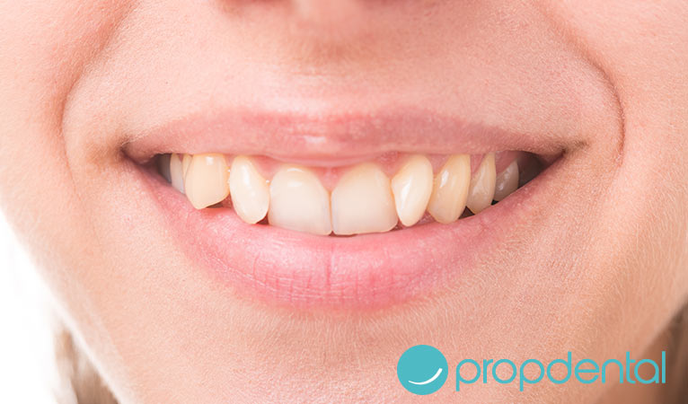 ¿Por qué tengo los dientes torcidos?