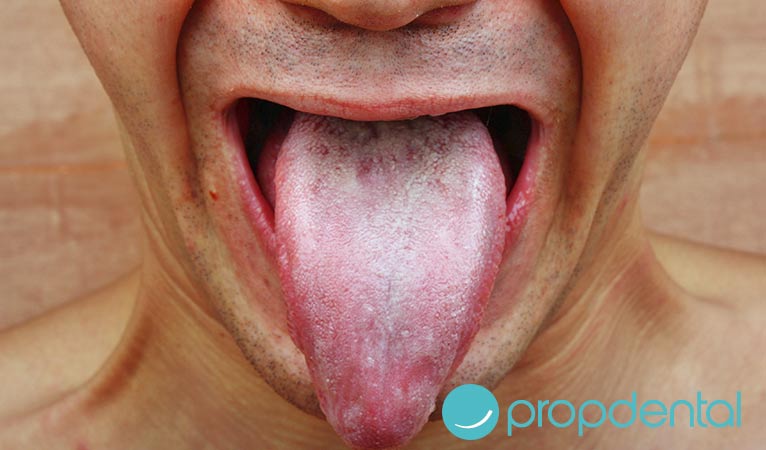 ¿Qué es la candidiasis bucal?