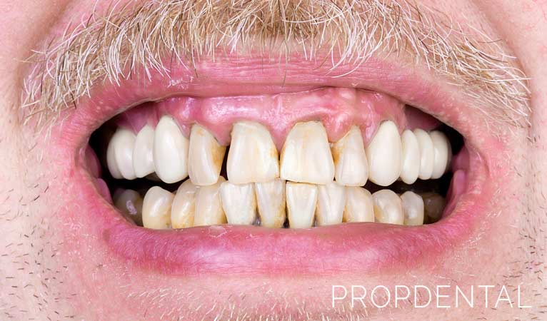5 causas del dolor de encías