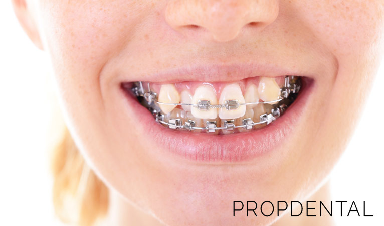 Preguntas frecuentes sobre llevar brackets