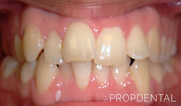¿Por qué tengo los dientes apiñados?