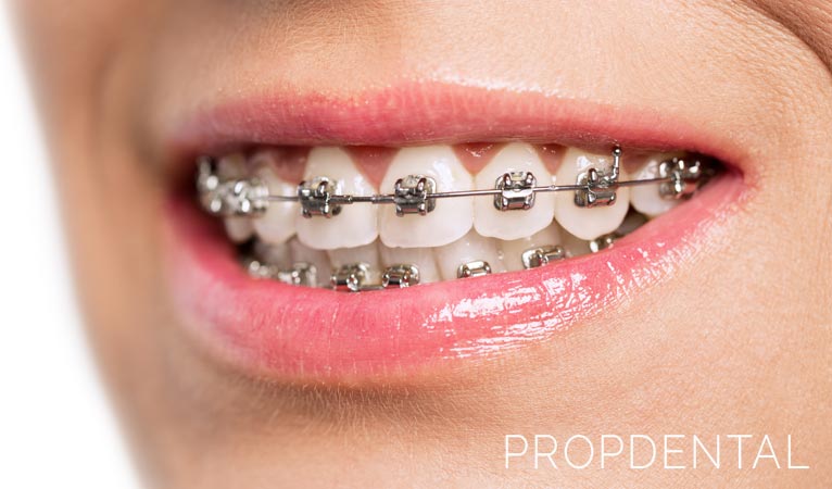 ¿Se puede llevar ortodoncia si tienes implantes dentales?