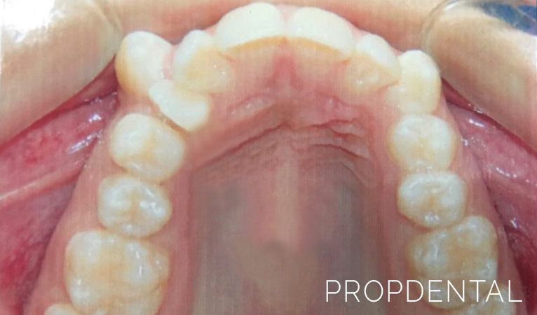 Extracción de dientes supernumerarios