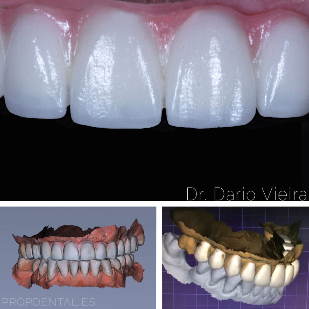 escaner intraoral protesis sobre implantes diseñados y fabricados con cadcam