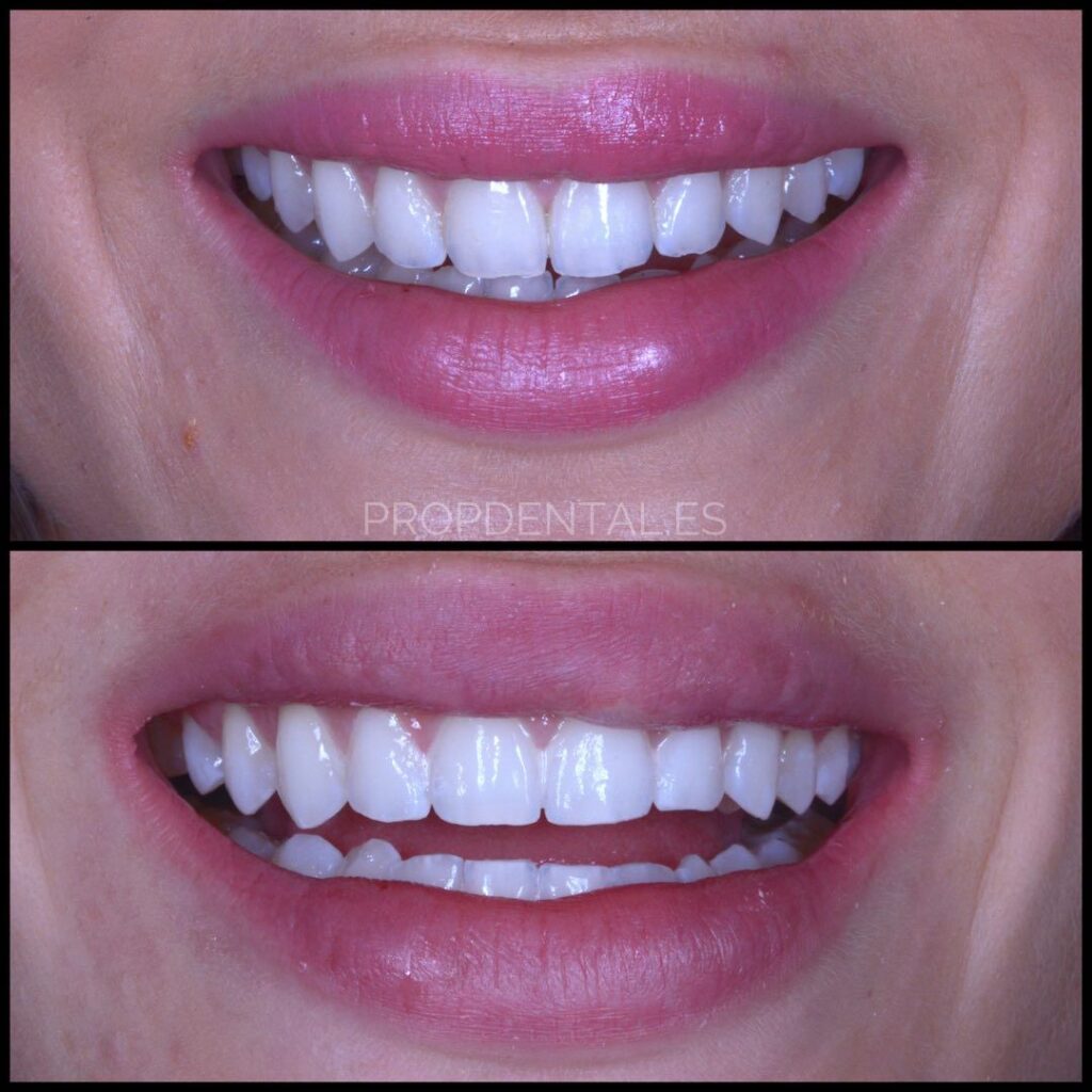 testimonio blanqueamiento dental led miss world
