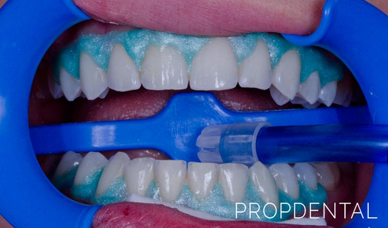 quemadura en la encía por blanqueamiento dental