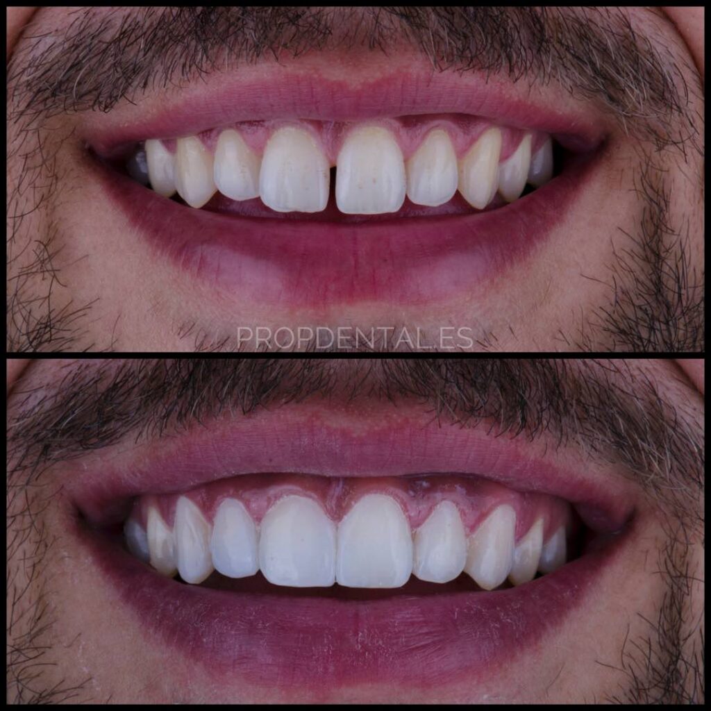 carillas composite antes después diastema