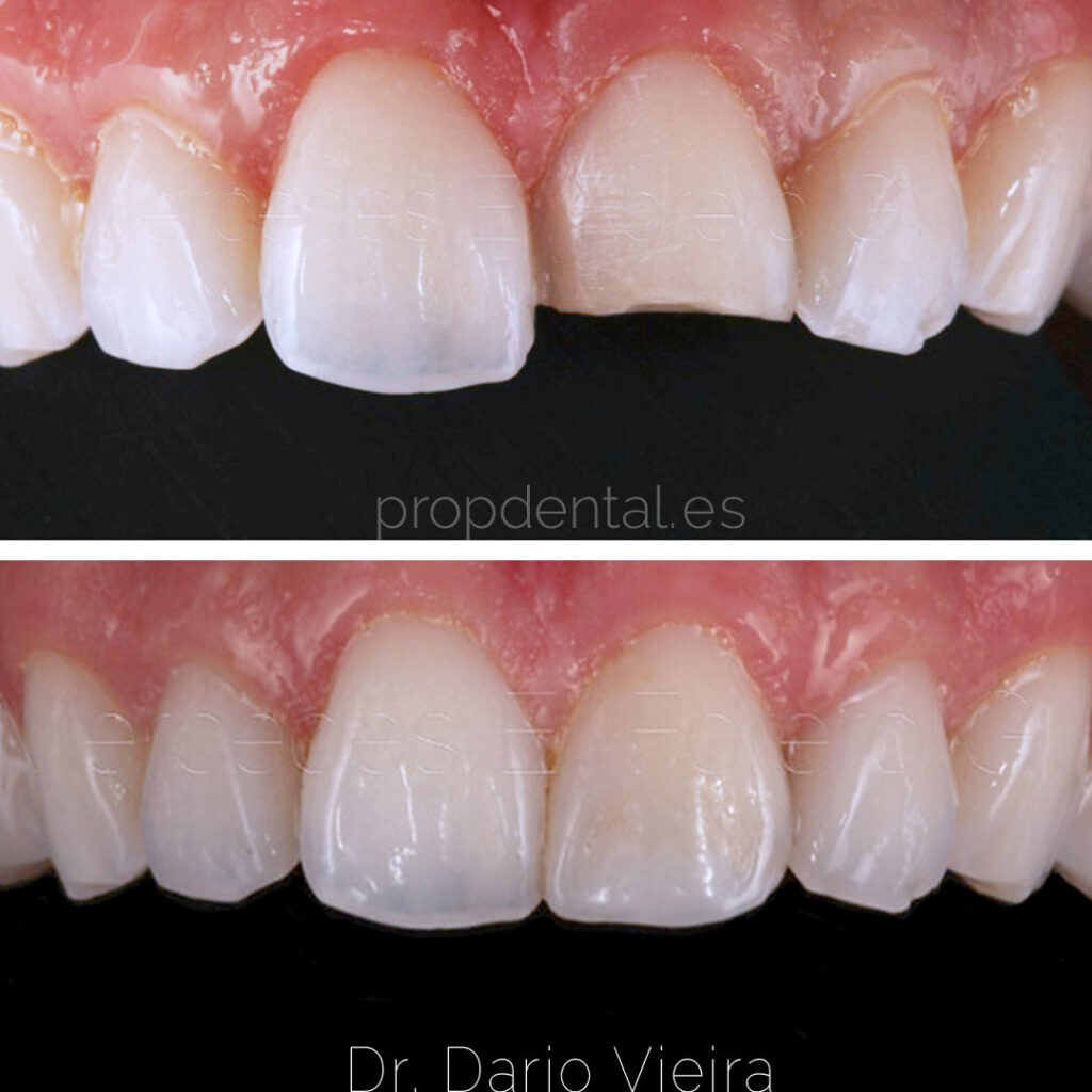 fractura-dental