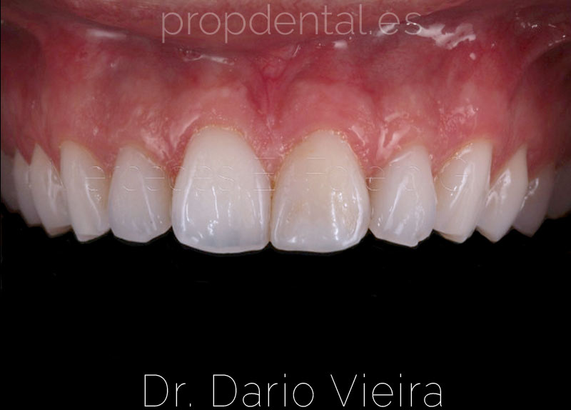 fractura-dental-acabada