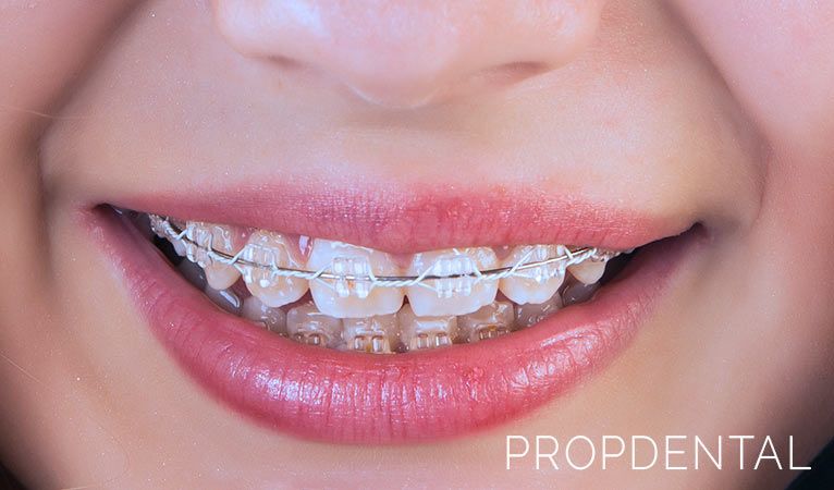 que tipo de brackets necesito