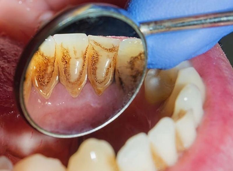 flexible Viaje Tristemente Precio limpieza dental con ultrasonidos en Barcelona