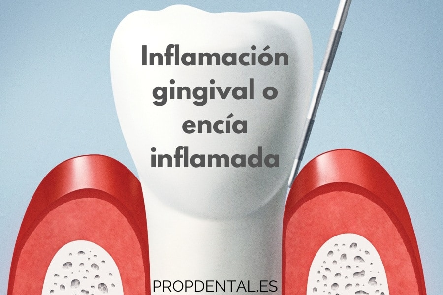 inflamacion-gingival o encia inflamada