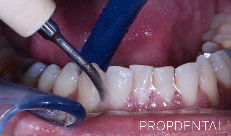 flexible Viaje Tristemente Precio limpieza dental con ultrasonidos en Barcelona