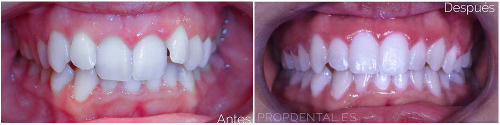 tratamiento ortodoncia brackes antes después