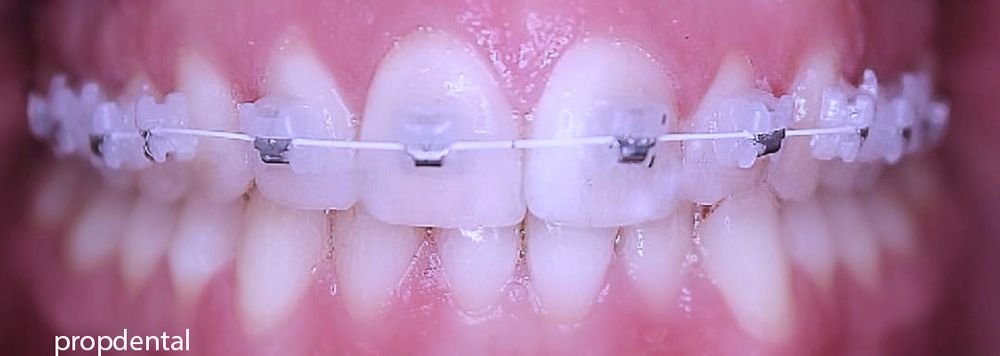 brackets de zafiro para ortodoncia estética