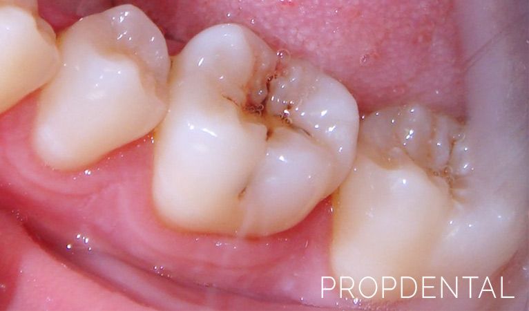 complicaciones de la caries dental