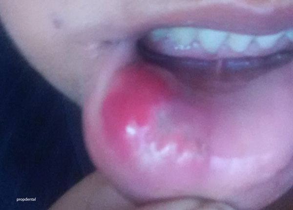 me operaron de un mucocele en el labio