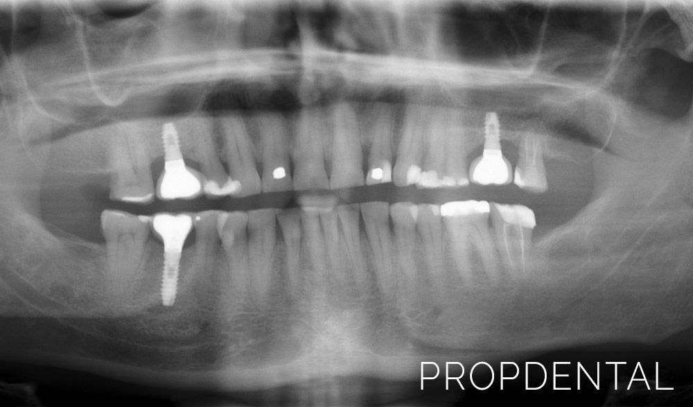 radiografia de la prótesis sobre implantes dental