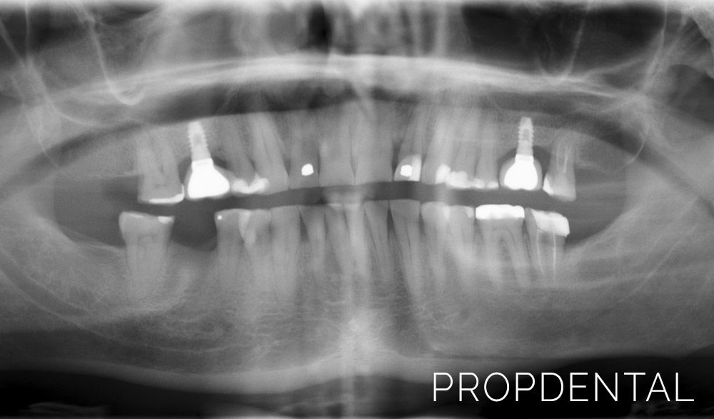 radiografia para poner un implante dental