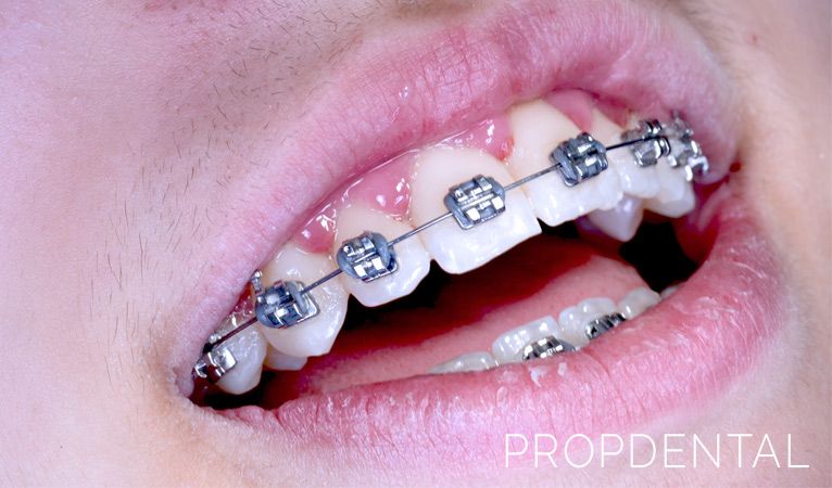 ventajas e inconvenientes la ortodoncia brackets metalicos