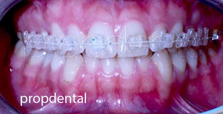 brackets dentales de ortodoncia