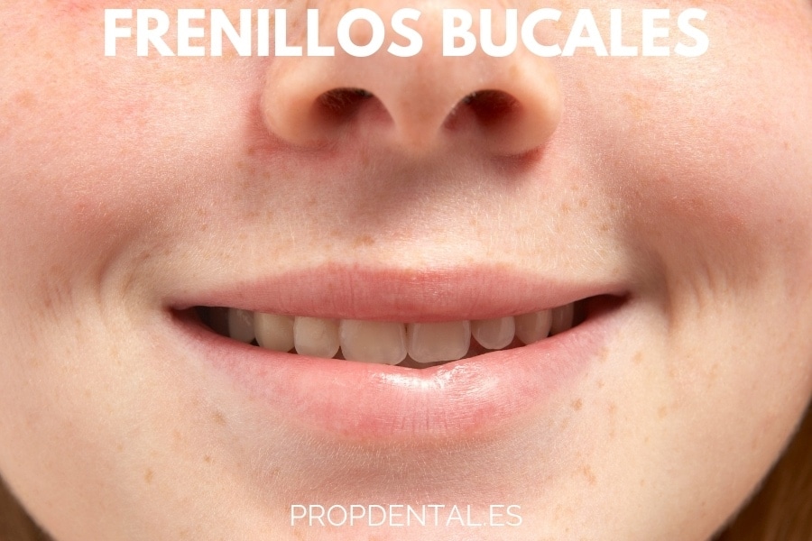 frenillos bucales