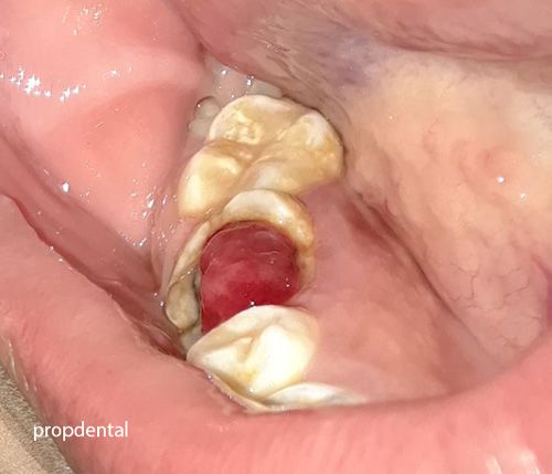 muela picada por caries para extracción