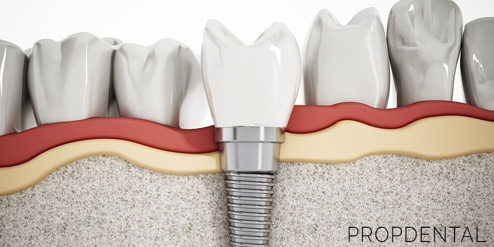 osteointegración de los implantes dentales